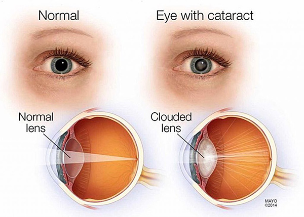 Difference between a normal eye and one with cataracts