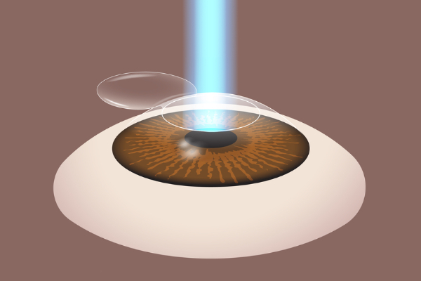lasik-eye-surgery-reshaping-