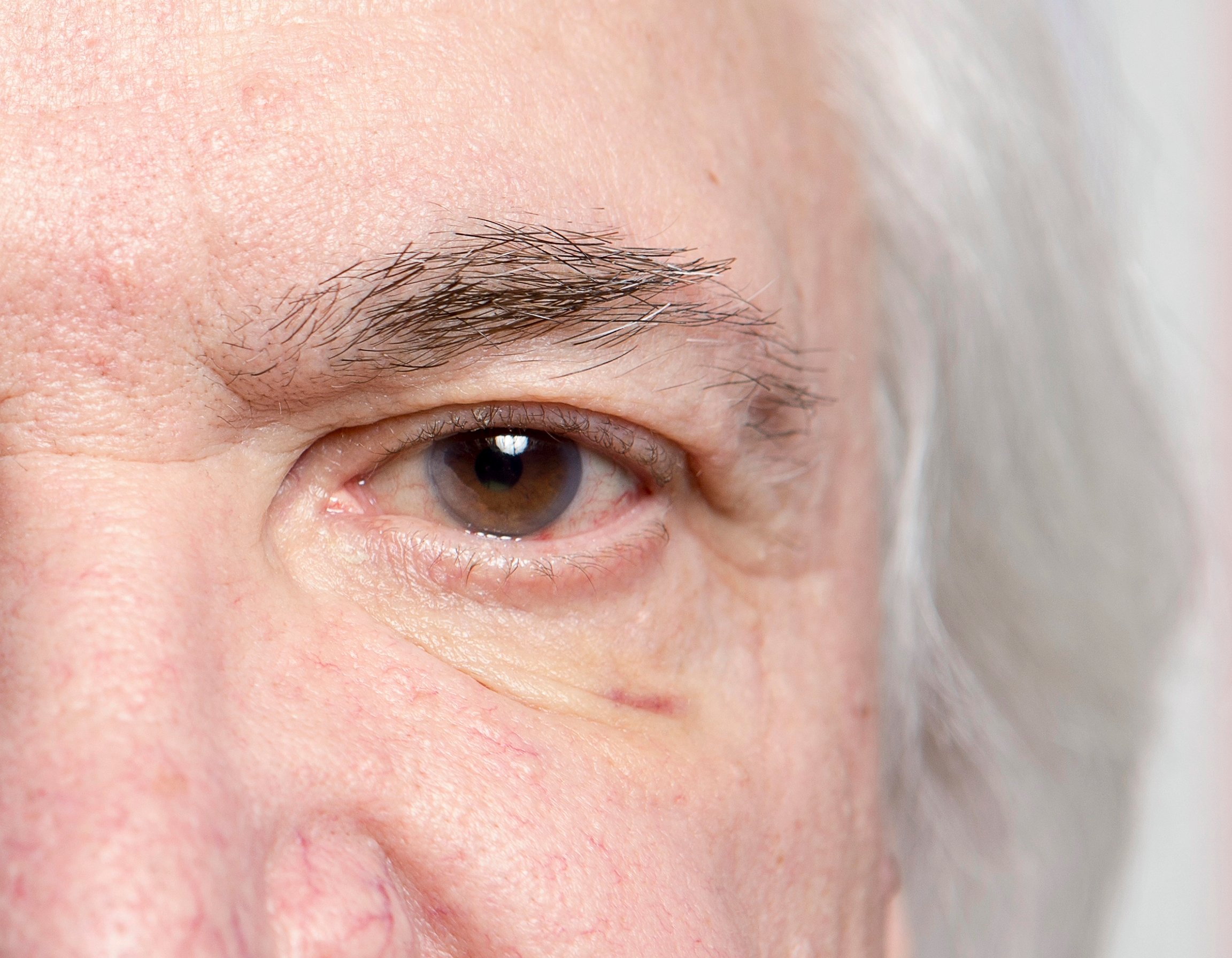 Glaucoma-Procedure