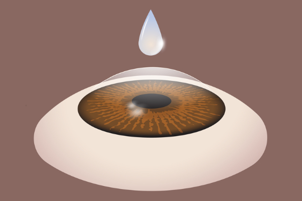 Numbing anesthetic eye drops applied to the eye to prepare for PRK surgery