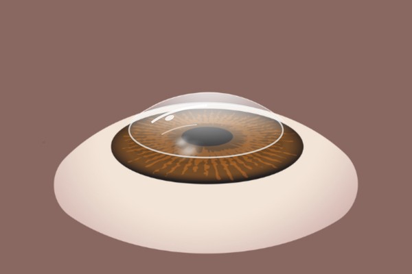 Protective bandage contact lens placed on the eye after PRK surgery