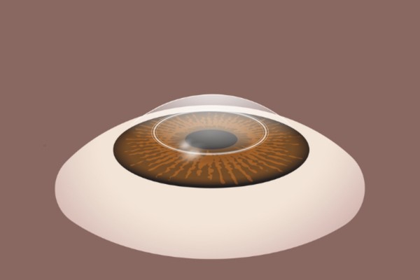 Corneal epithelium being removed to expose the underlying tissue during PRK