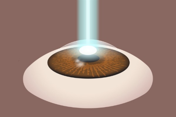 Excimer laser reshaping the cornea during PRK photorefractive keratectomy